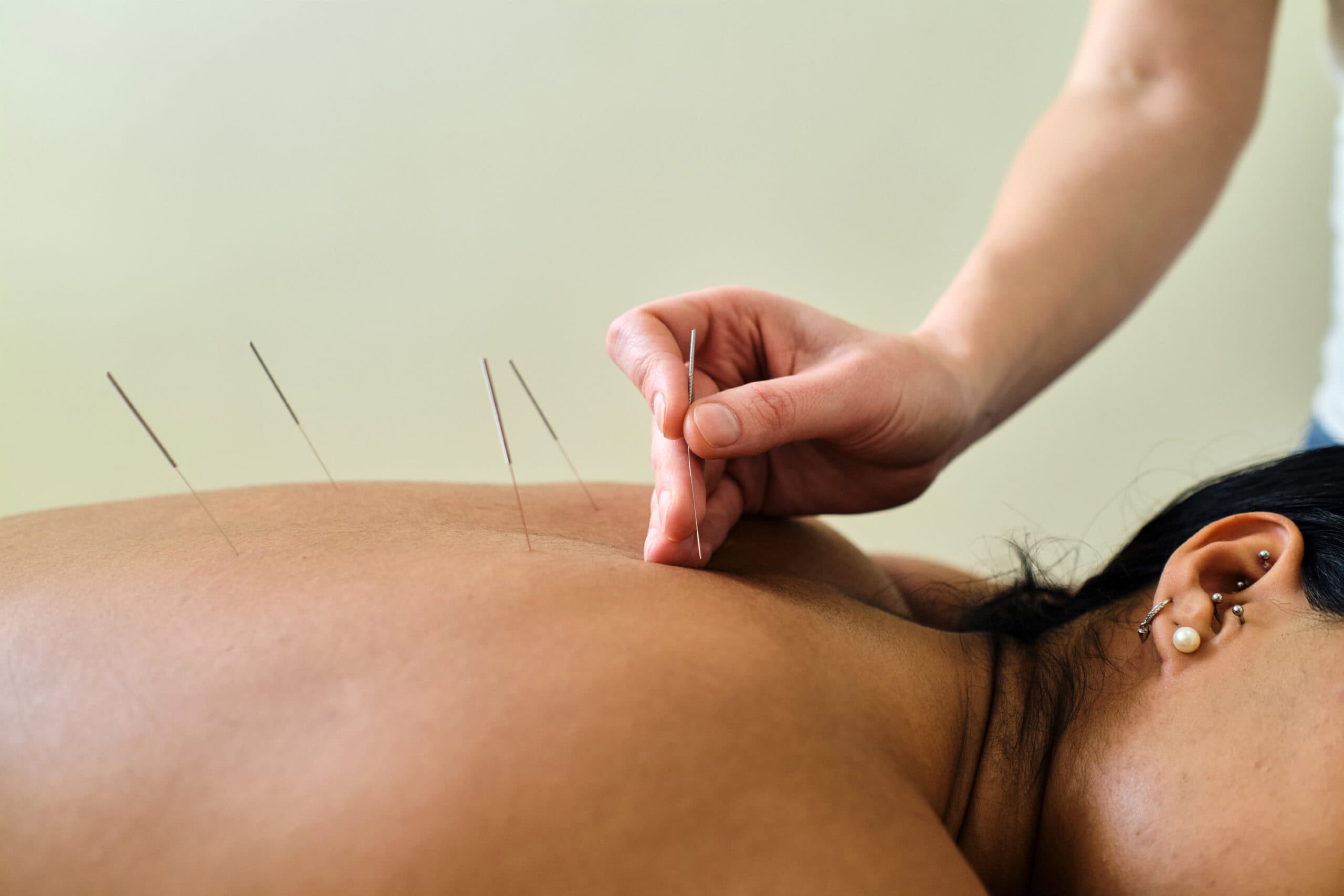 Masseuse putting acupuncture needles in young latin girl's back. Masseuse putting acupuncture needles in young latin girl's back.